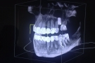 Perda ssea dentria pode causar perda total de dentes