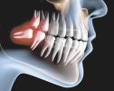 Mitos e verdades sobre o dente siso