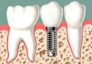 Nova tcnica que promete implantes dentais sem cortes e sem dor