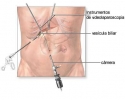 Tcnica para cirurgia de vescula 